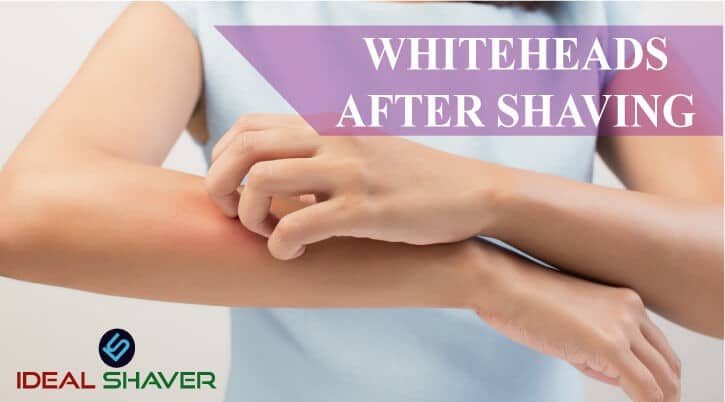 whiteheads-after-shaving-update-2020-ideal-shaver